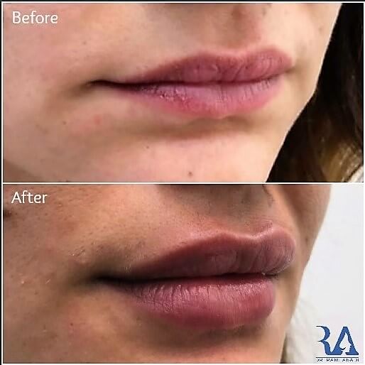 Lip Enhancement with Fillers