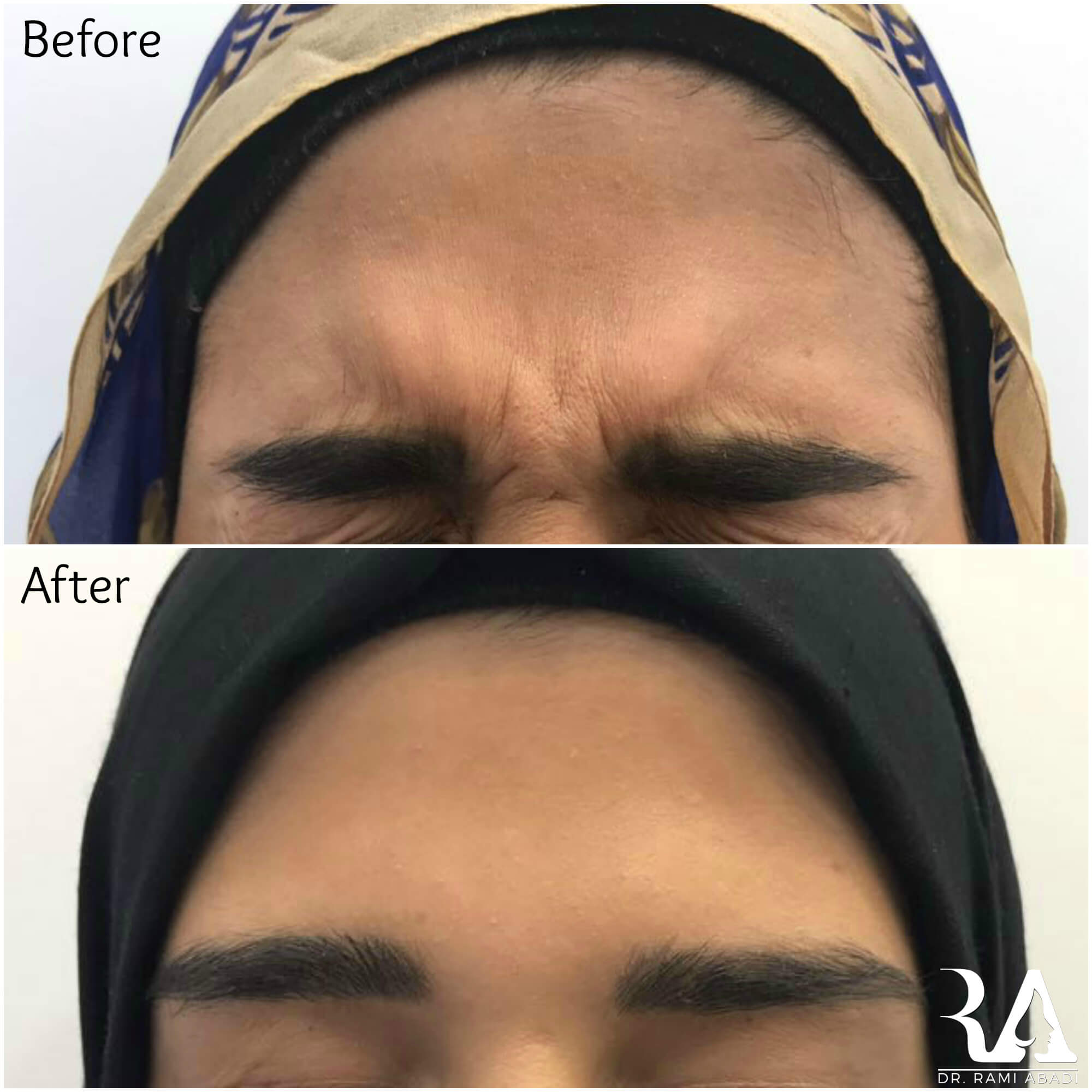 Botox for Frown Lines