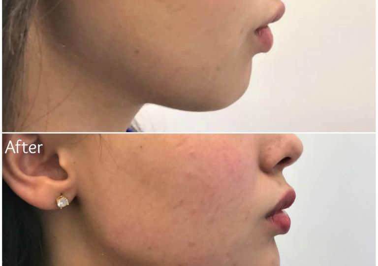 Chin Enhancement and Jawline Definition with Fillers