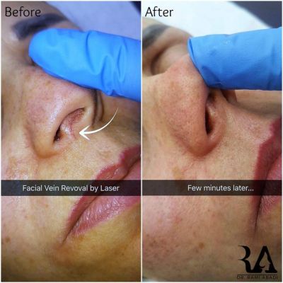 Vein Removal with Laser