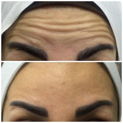 Botox for forehead lines and wrinkles
