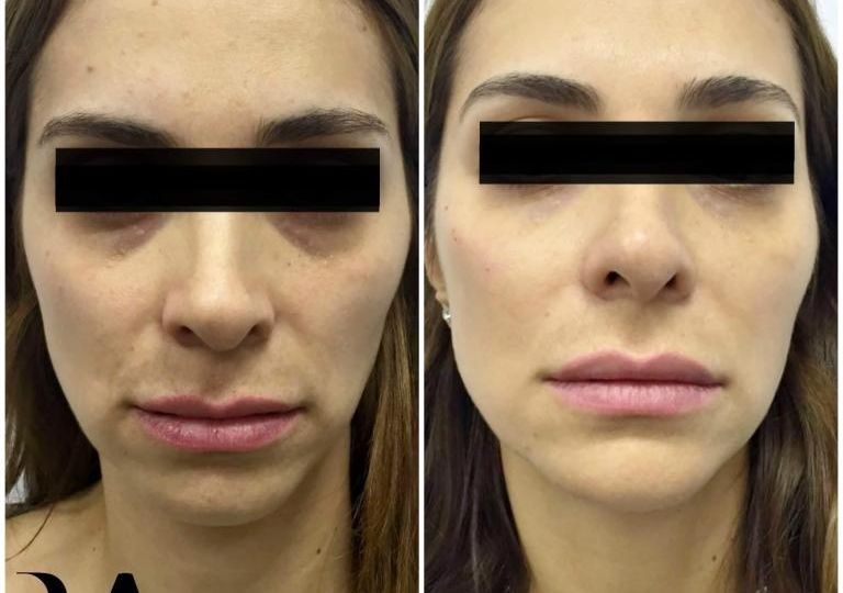 Fillers for Full Face