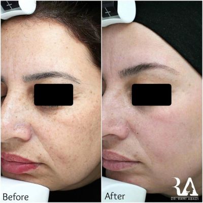 Treatment of freckles, pigmentation and skin texture