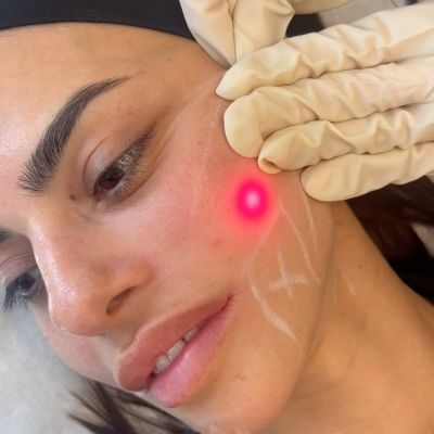 Experience the power of non-invasive transformation with Endolift. Lift, tighten and rejuvenate your skin, instantly!